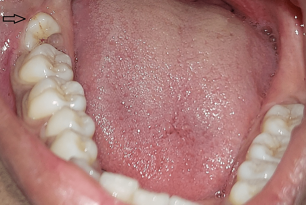 Impacted-third-molar