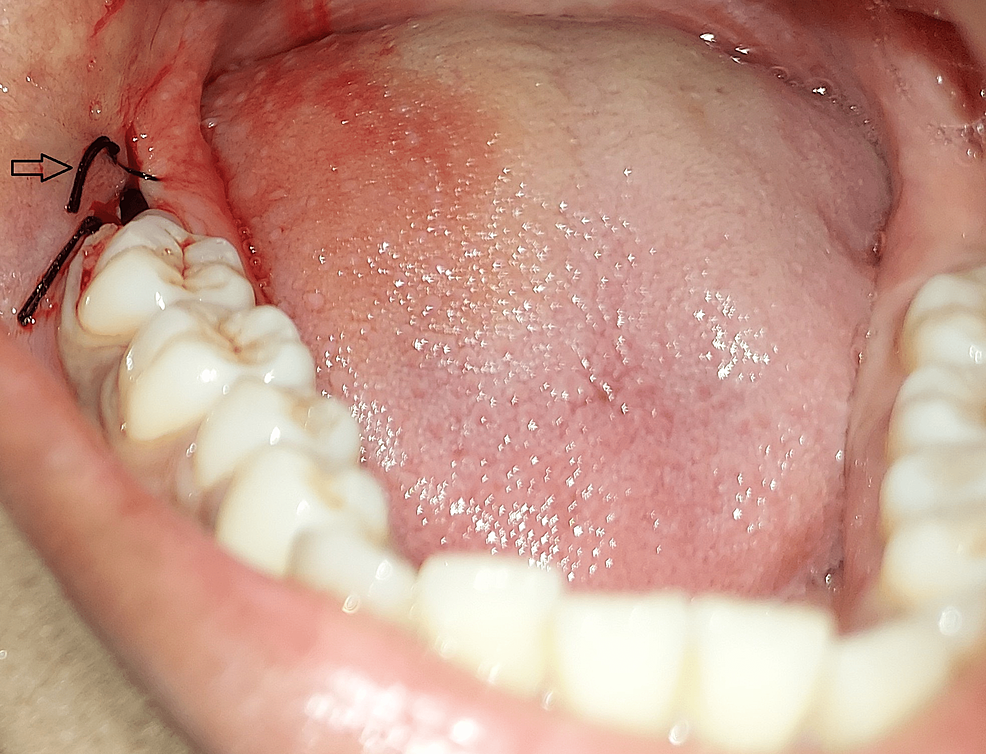 Mandibular-third-molar-extracted-and-sutured