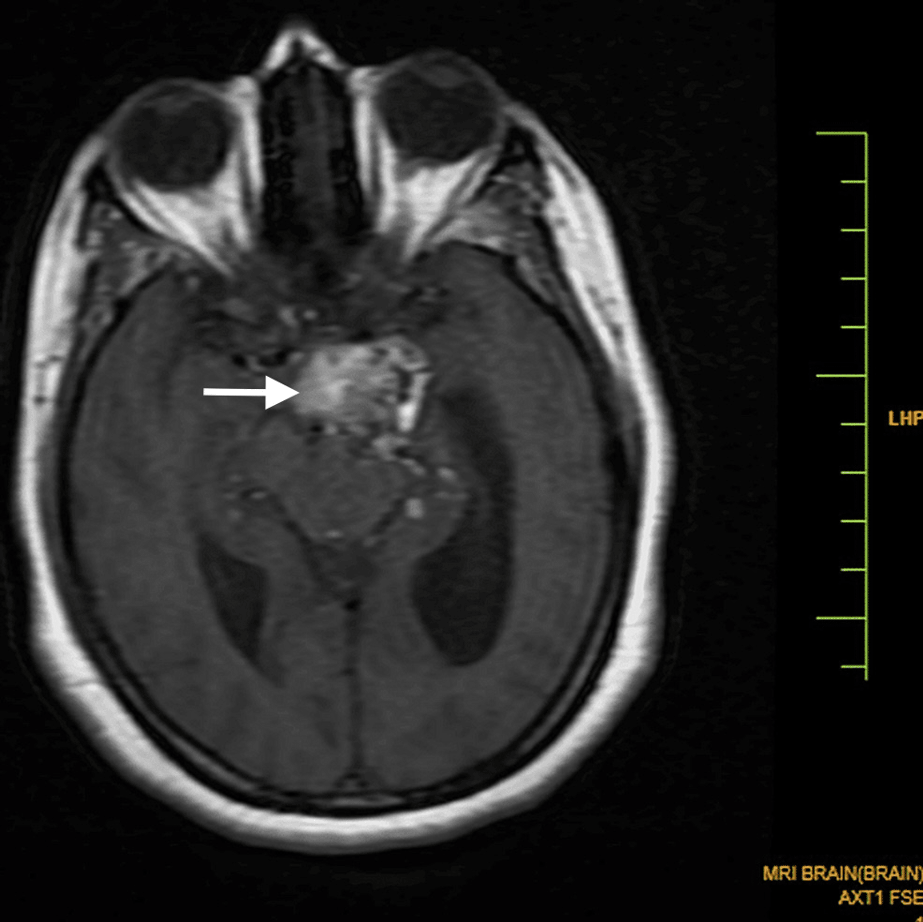 Magnetic Resonance Imaging Findings In A Rare Case Of A Ruptured Intracranial Dermoid Cyst Cureus 9257