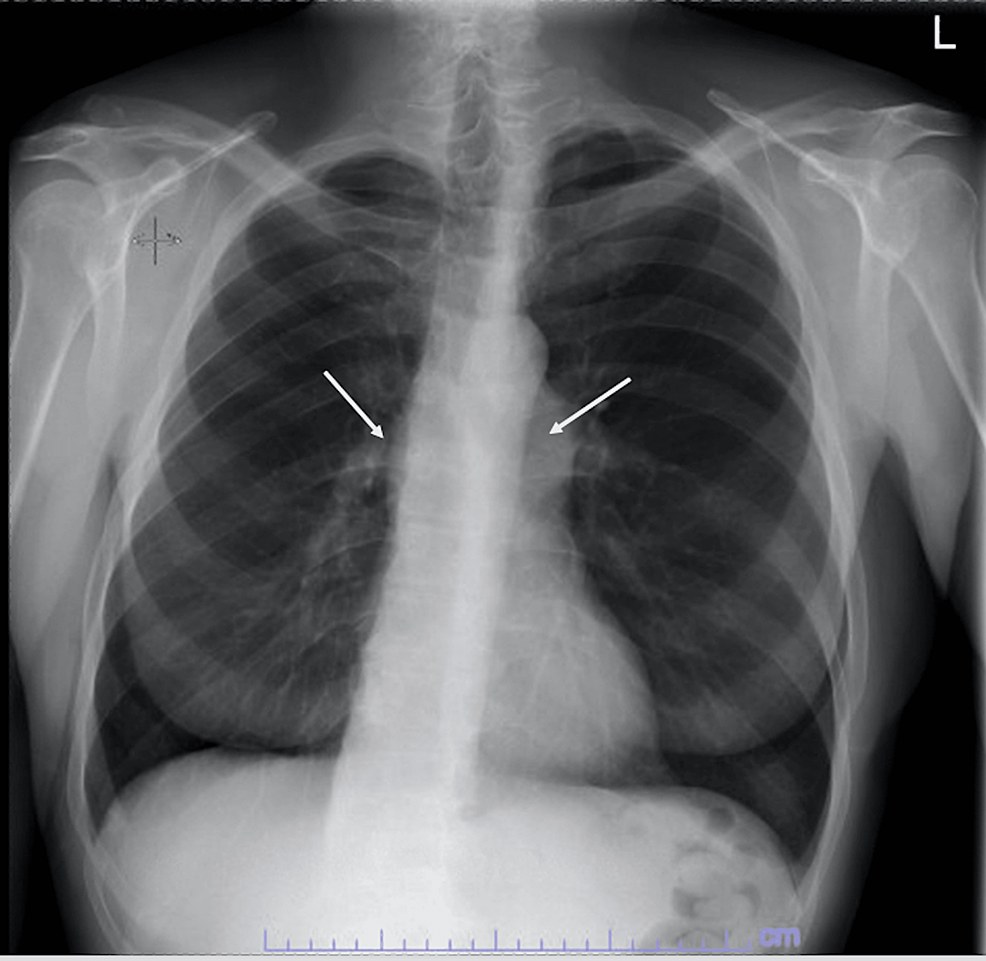 Cureus | A Rare Case of Pulmonic and Aortic Valve Infective ...