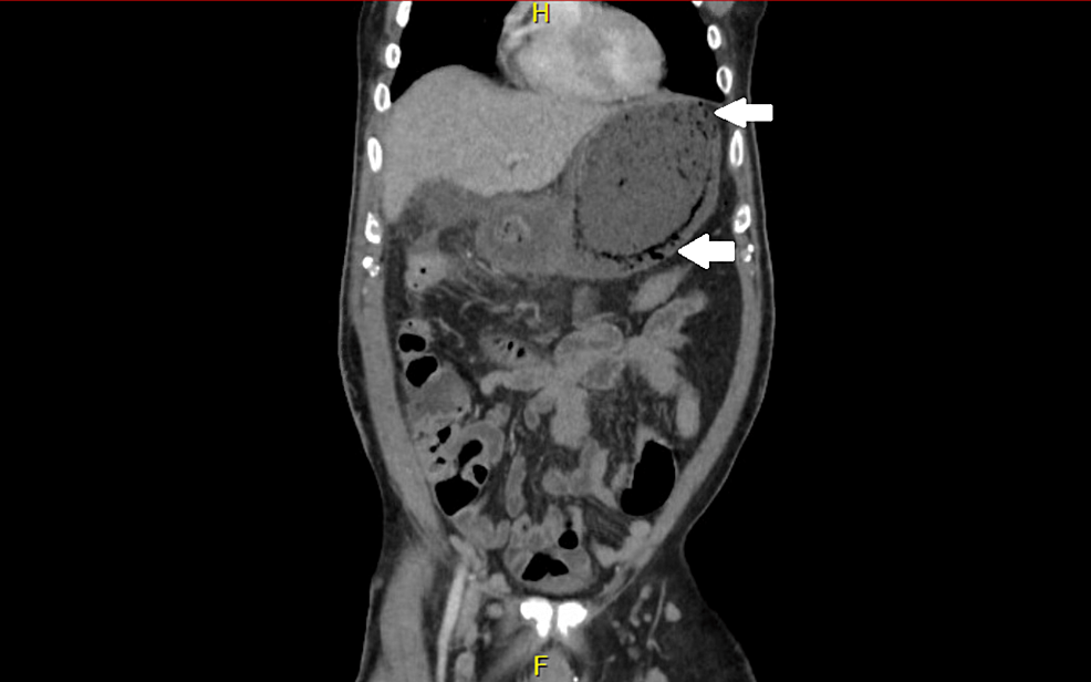 Cureus Nonoperative Management of Sarcina ventriculiAssociated