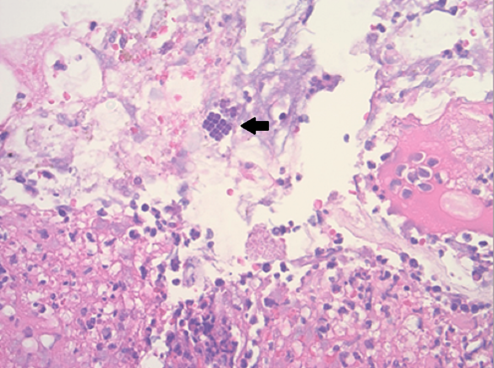 Cureus Nonoperative Management of Sarcina ventriculiAssociated