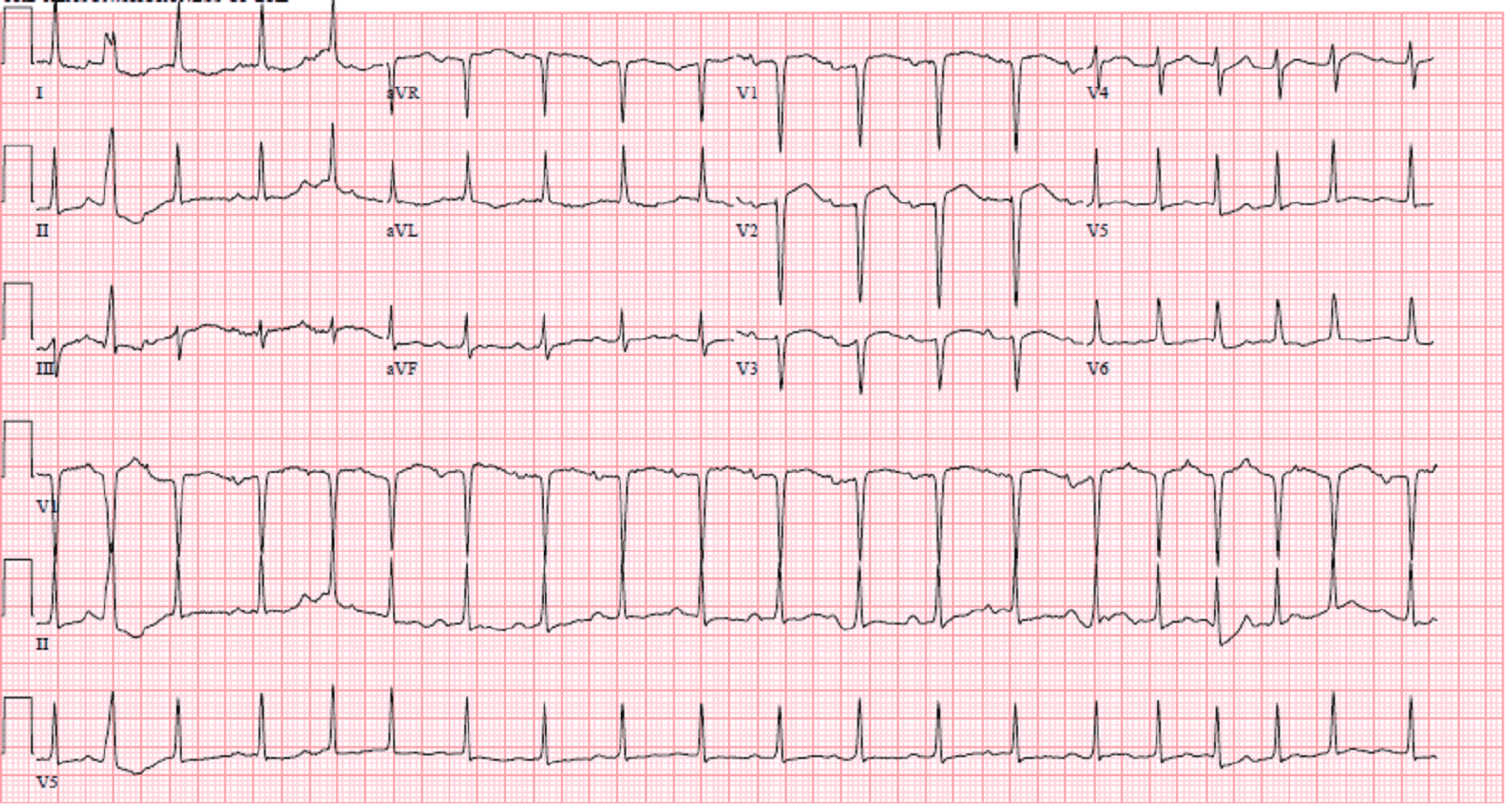 Cureus | Valvular Heart Disease Presenting As Sympathetic Crashing ...