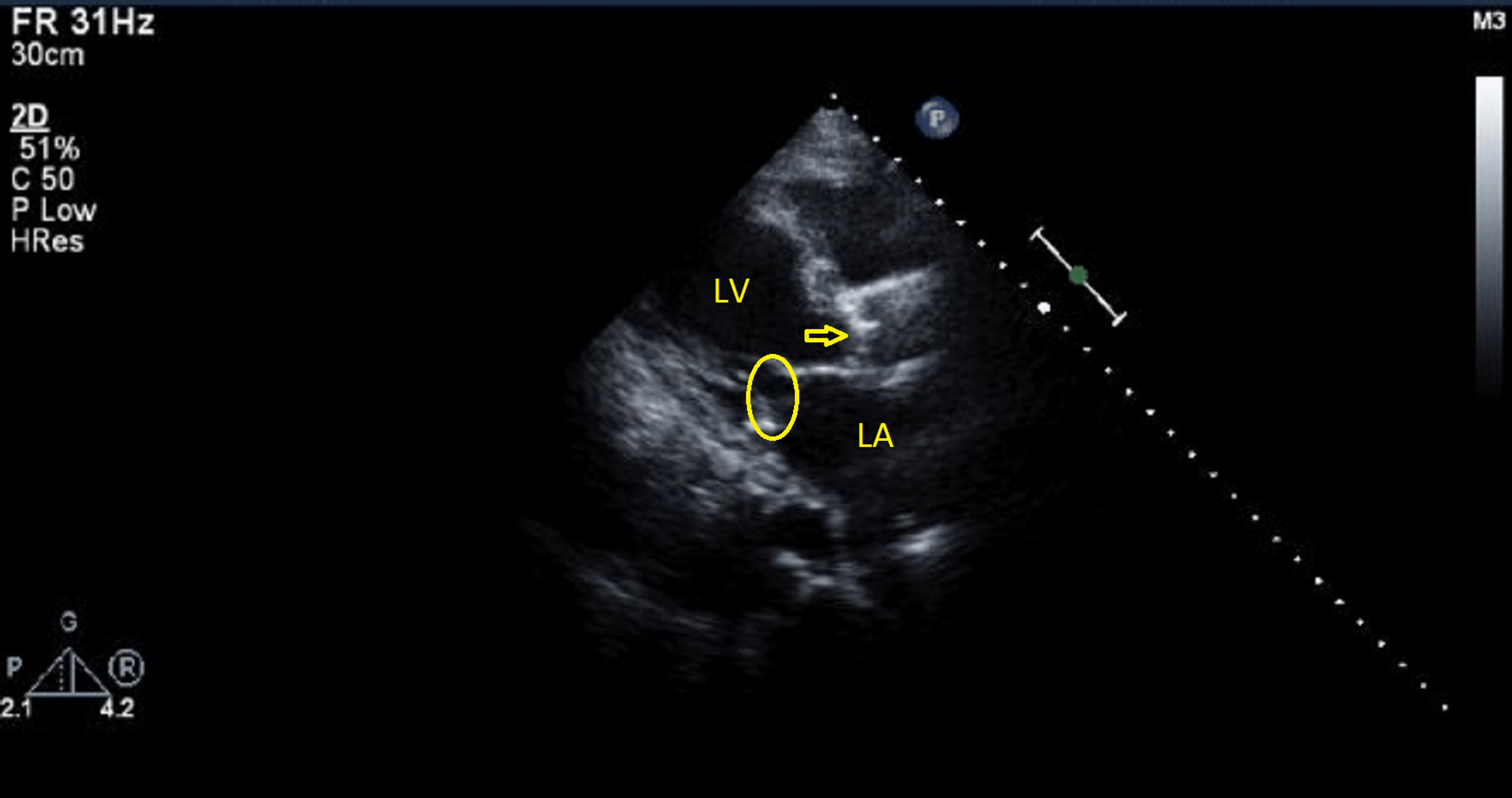 Cureus | Valvular Heart Disease Presenting As Sympathetic Crashing ...