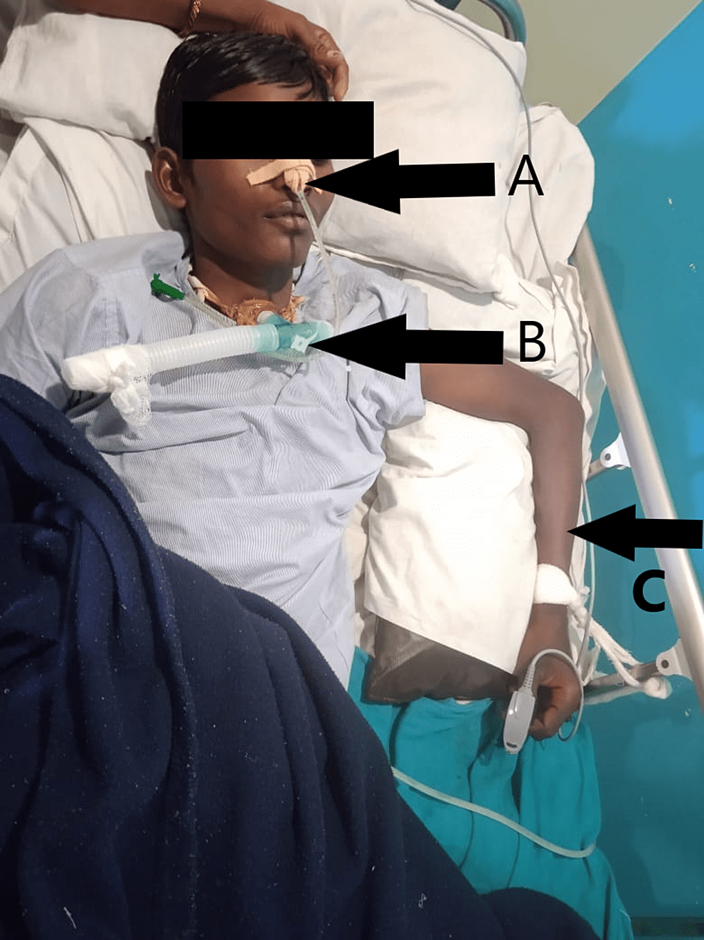A:-Ryle’s-tube-(in-situ);-B:-tracheostomy-tube-(in-situ);-C:-left-elbow-and-wrist-held-in-flexion-with-10-degrees-of-elbow-and-wrist-contracture-and-supported-with-pillow.