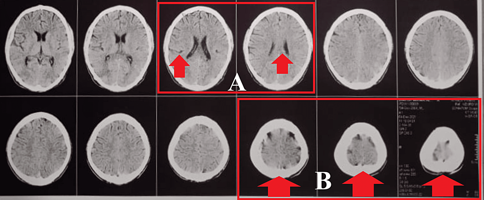 A:-MRI-scan-that-shows-hyper-intense-foci-near-the-corpus-callosum-of-the-brain;-B:-MRI-showing-subdural-hematoma.