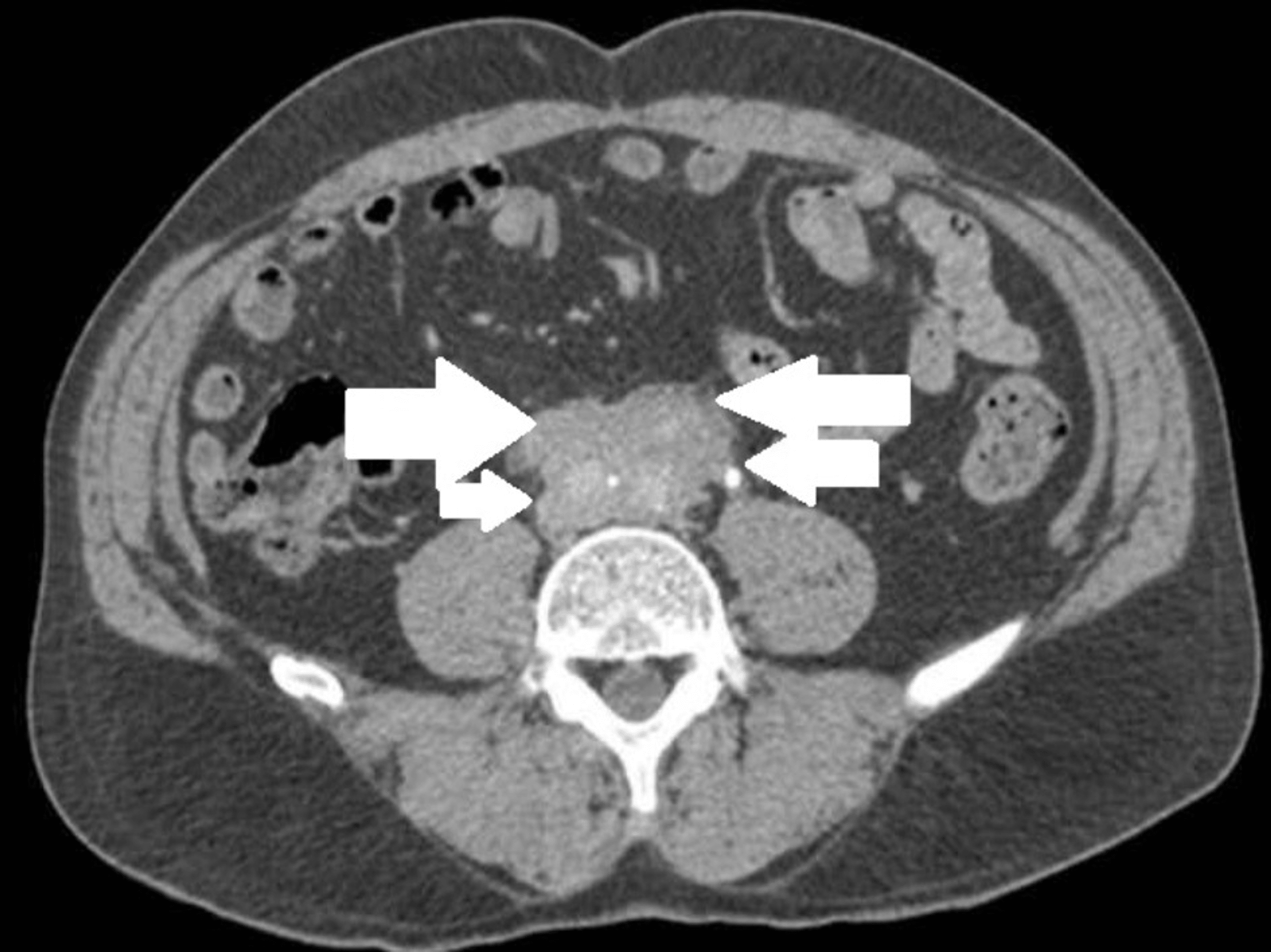 cureus-idiopathic-retroperitoneal-fibrosis-presented-as-urinary-tract