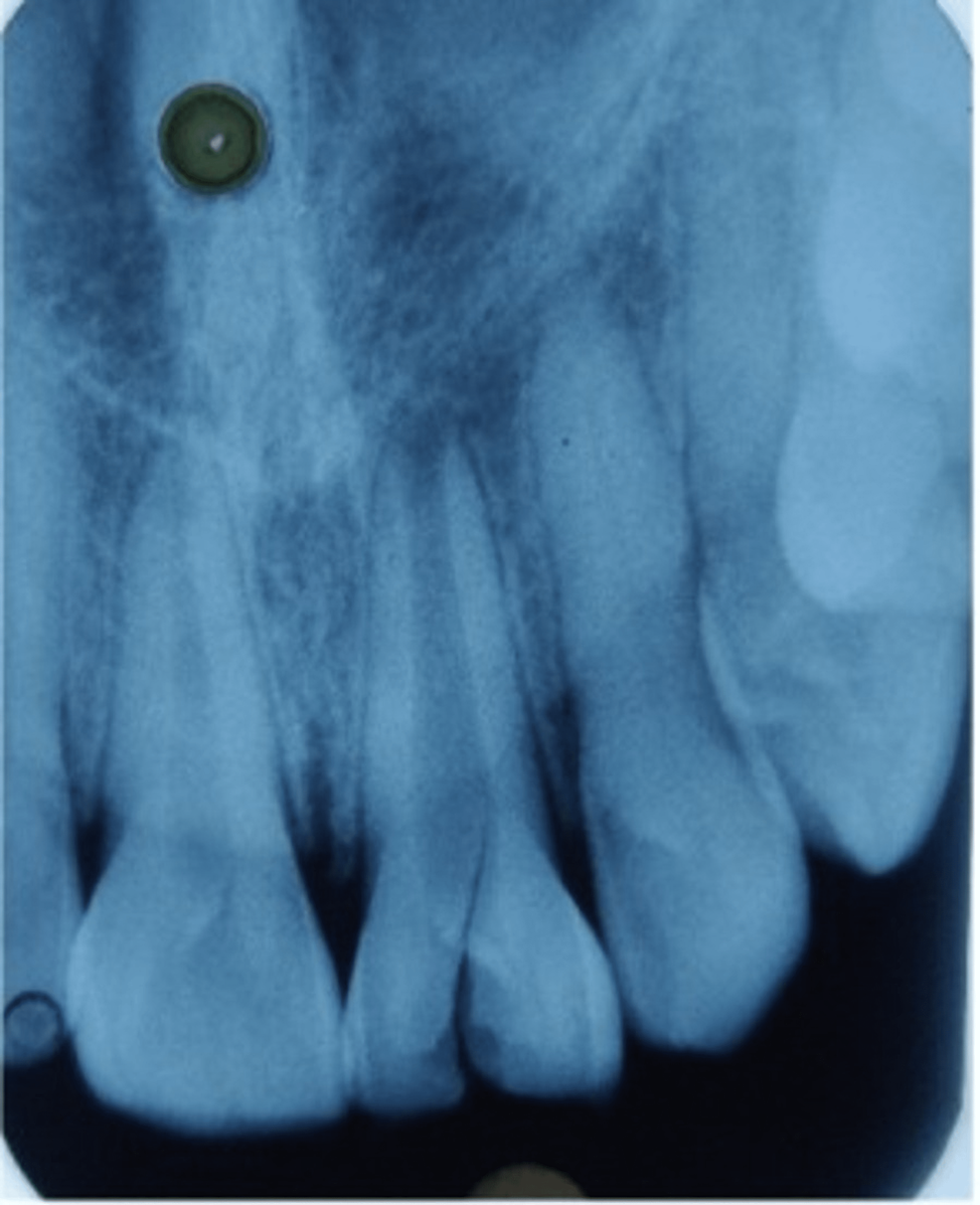 Cureus Management of Ellis ClassIV Fractured Tooth With an Open Apex