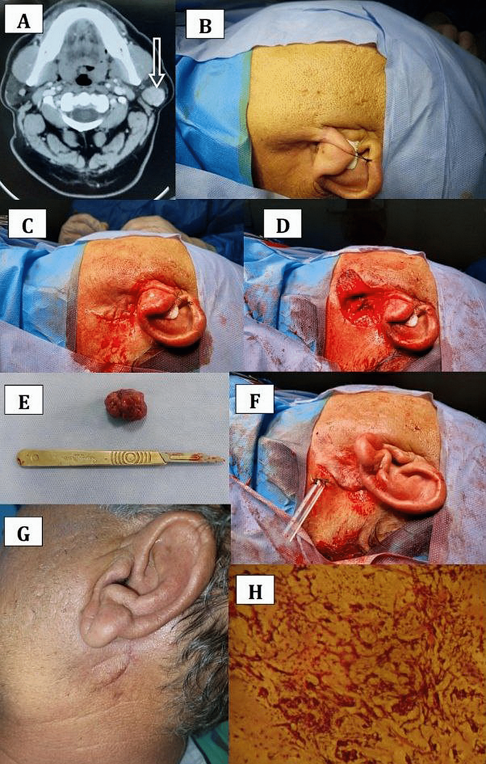 (A)-Axial-CT-revealing-(arrow)-a-mass-4-×-2.5-cm-in-the-left-parotid-gland.-(B)-Preoperative-view-and-site-prepared-for-surgery.-(C)-Incision.-(D)-Superficial-parotidectomy-done-with-preservation-of-the-facial-nerve.-(E)-Surgical-specimen-of-the-tumor.-(F)-Wound-closure-with-drain-placement.-(G)-Postoperative-view-four-weeks-after-the-surgery.-(H)-Histopathological-confirmation-(H&E-stain,-100×)-of-pleomorphic-adenoma.