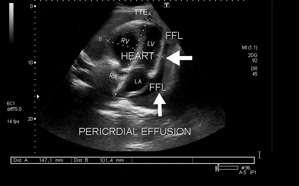 Transthoracic-echocardiography-(TEE)-Subcostal-View-Showing-Pericardial-Effusion.