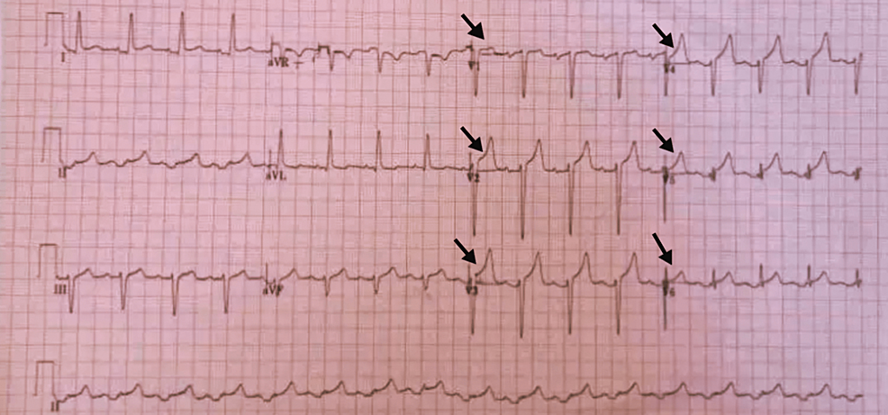 Electrocardiogram-(ECG)-of-the-Patient-Showing-Widespread-ST-Elevation.