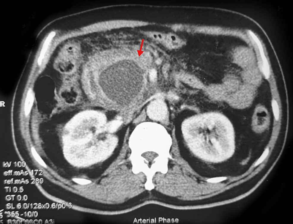 Pseudocyst-in-the-pancreas-on-CT-scan-abdomen
