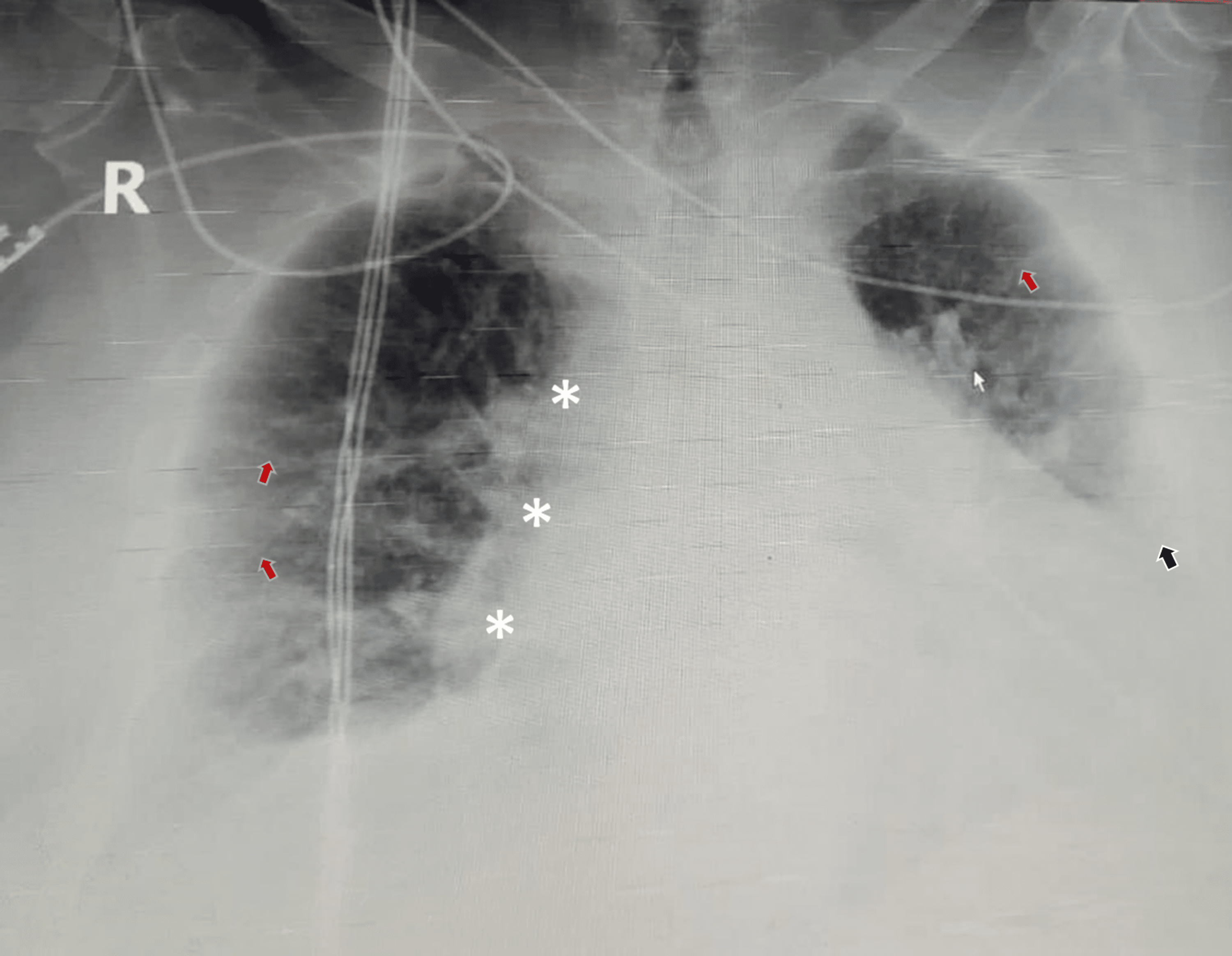 Cureus | Thoracic Segmental Spinal Anesthesia for Emergency  Cholecystectomy: A Case Report