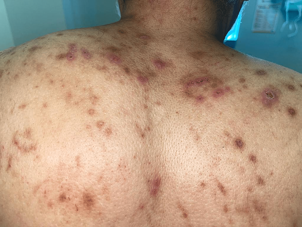 Upper-back-showing-excoriated-papules-and-nodules-in-a-butterfly-distribution.-
