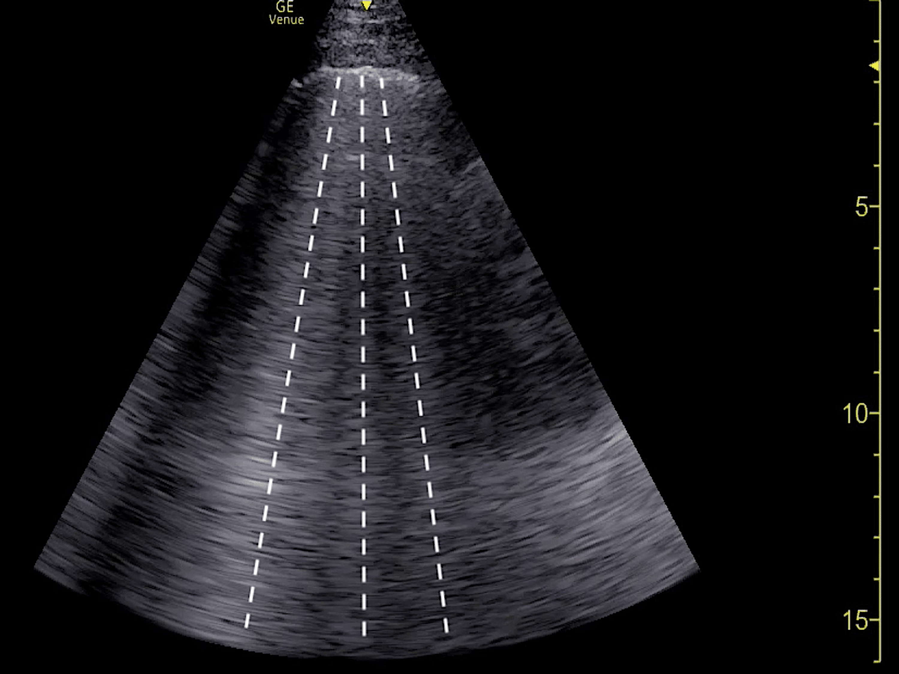 Cureus Bedside Echocardiography Diagnosis of Tricuspid Valve