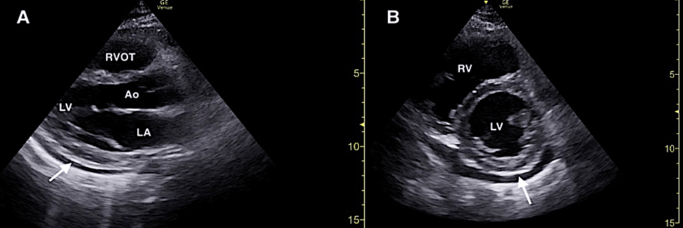 Focused-cardiac-ultrasound-demonstrating-a-small-pericardial-effusion-(solid-white-arrow)-in-the-parasternal-long-(A)-and-parasternal-short-(B)-windows.-