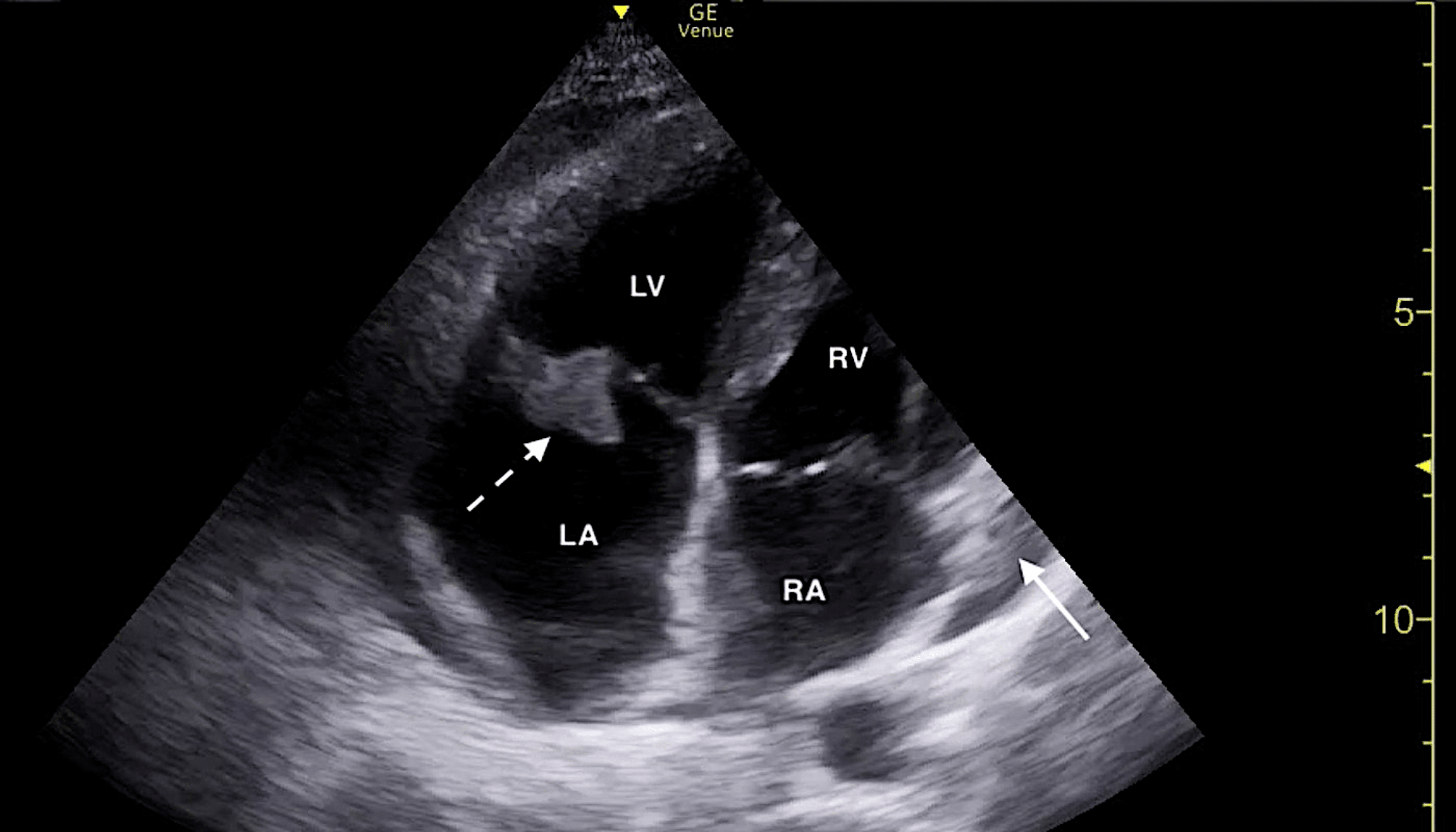 Cureus Bedside Echocardiography Diagnosis of Tricuspid Valve