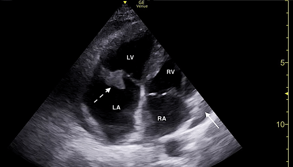 Focused-cardiac-ultrasound-demonstrating-a-tricuspid-valve-vegetation-(dotted-white-arrow)-and-small-pericardial-effusion-(solid-white-arrow)-in-the-apical-four-chamber-window.-