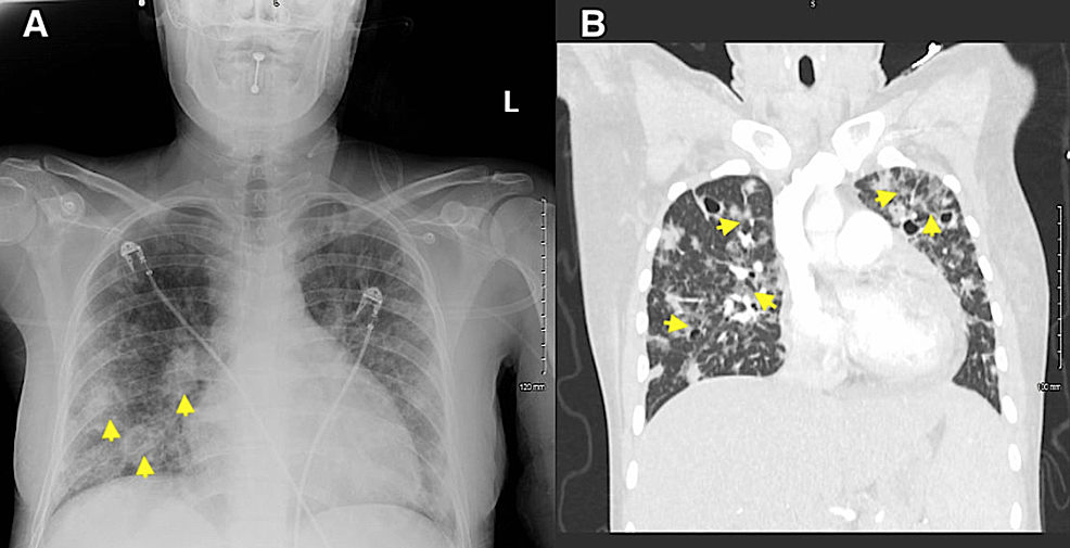 Portable-chest-radiography-demonstrating-mild-cardiomegaly-and-infiltrates-(yellow-arrowheads)-representative-of-septic-emboli.-(B)-Computed-tomography-pulmonary-angiography-demonstrating-scattered-patchy-ground-glass-infiltrates-in-a-perihilar-distribution-and-numerous-nodular-densities-with-central-cavitation-throughout-both-lungs-(yellow-arrowheads),-representative-of-septic-emboli.