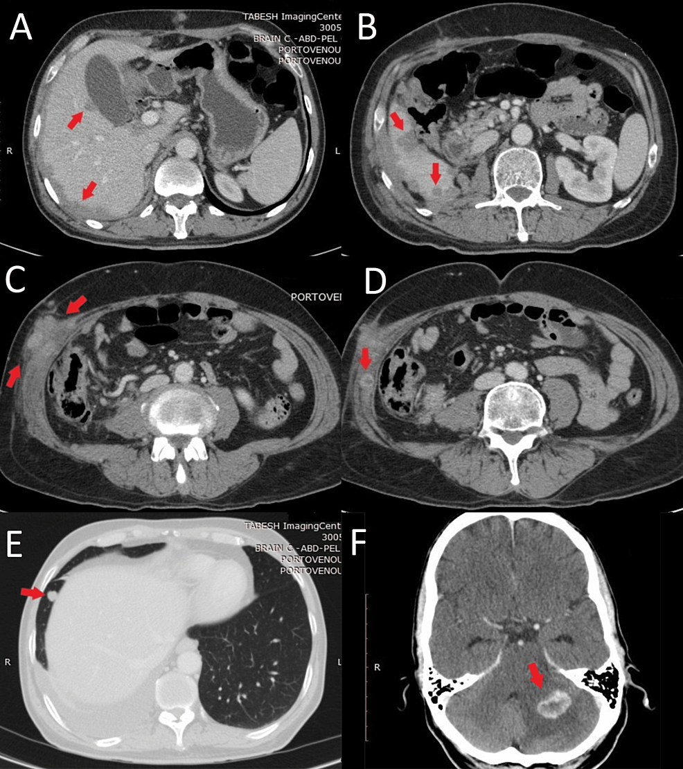 CT-images-for-multiple-metastatic-lesions
