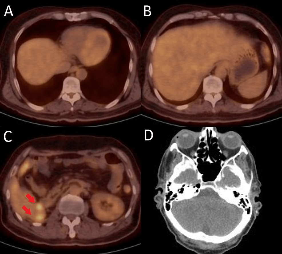 PET/CT-images-after-four-months-of-treatment-with-nivolumab