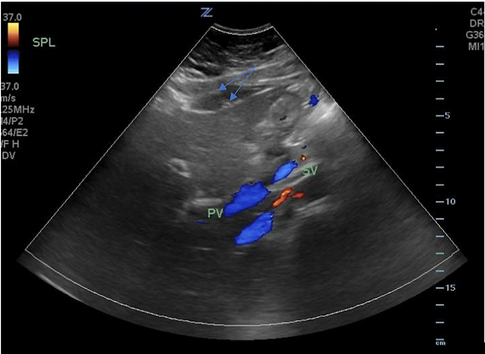 The-ultrasound-of-the-right-upper-quadrant-of-the-abdomen-shows-multiple-stones-along-the-gallbladder-without-associated-gallbladder-wall-thickening-or-pericholecystic-fluid.