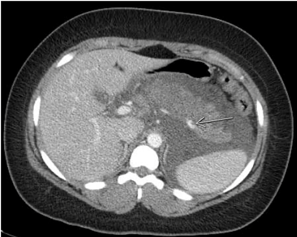 A-repeat-CT-of-the-abdomen-and-pelvis-(axial-view)-with-contrast,-performed-two-days-after-the-first-CT-showed-worsening-pancreatitis-with-signs-of-liquefactive-necrosis-associated-with-left-greater-than-right-basilar-subsegmental-consolidation-and-showed-interval-narrowing-of-the-splenic-vein-with-nonocclusive-thrombus.