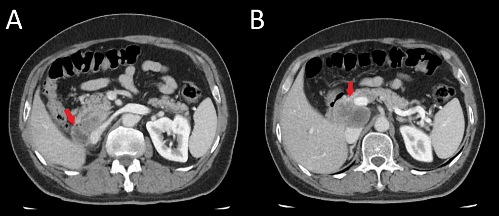 Abdominal-CT-scan