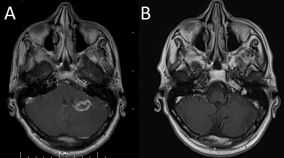 Pre-treatment-(A)-and-post-treatment-(B)-brain-MRI