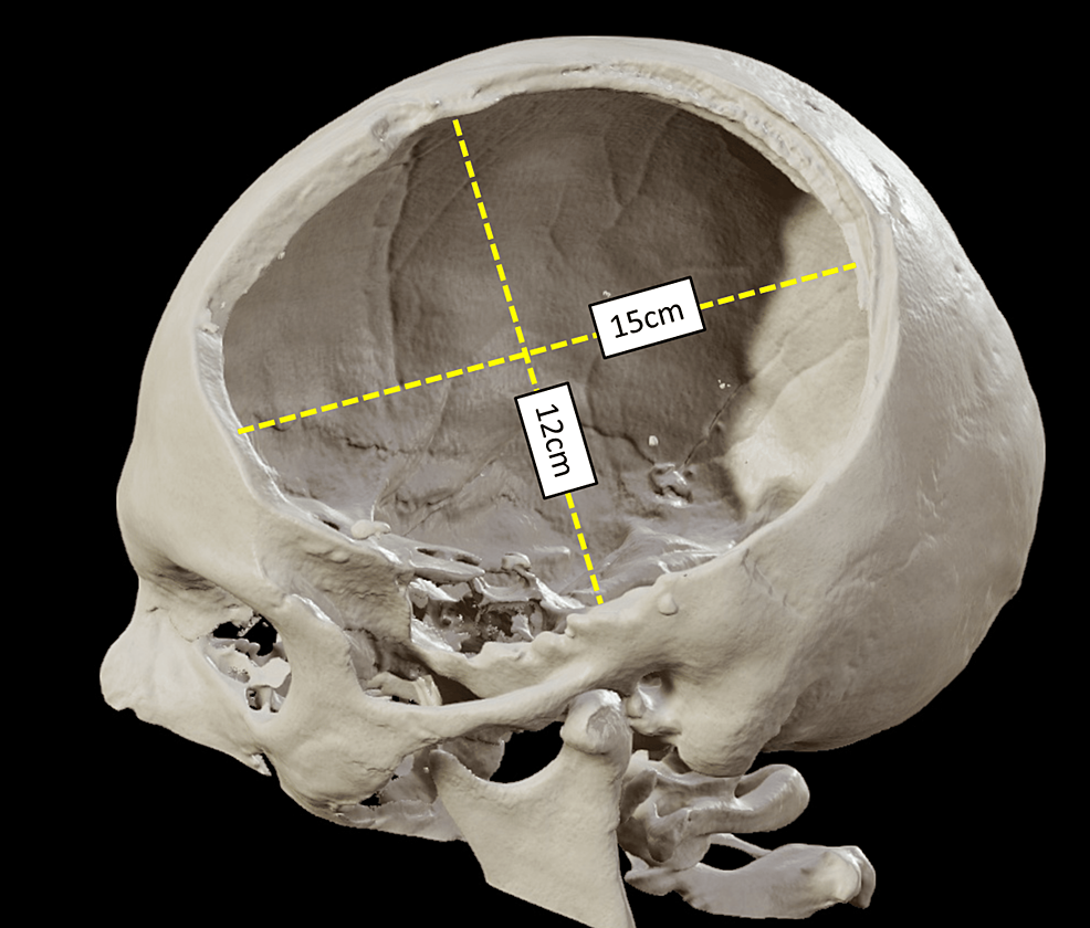 cureus-primary-decompressive-craniectomy-after-traumatic-brain-injury