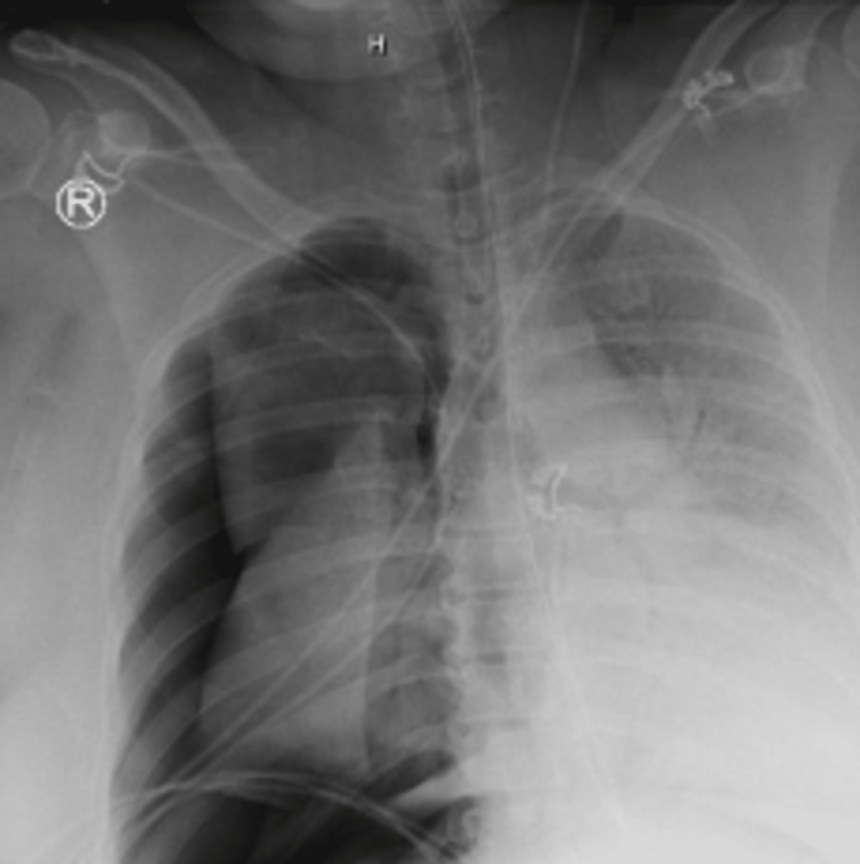 Cureus Incidence of Barotrauma in COVID19 Patients Requiring