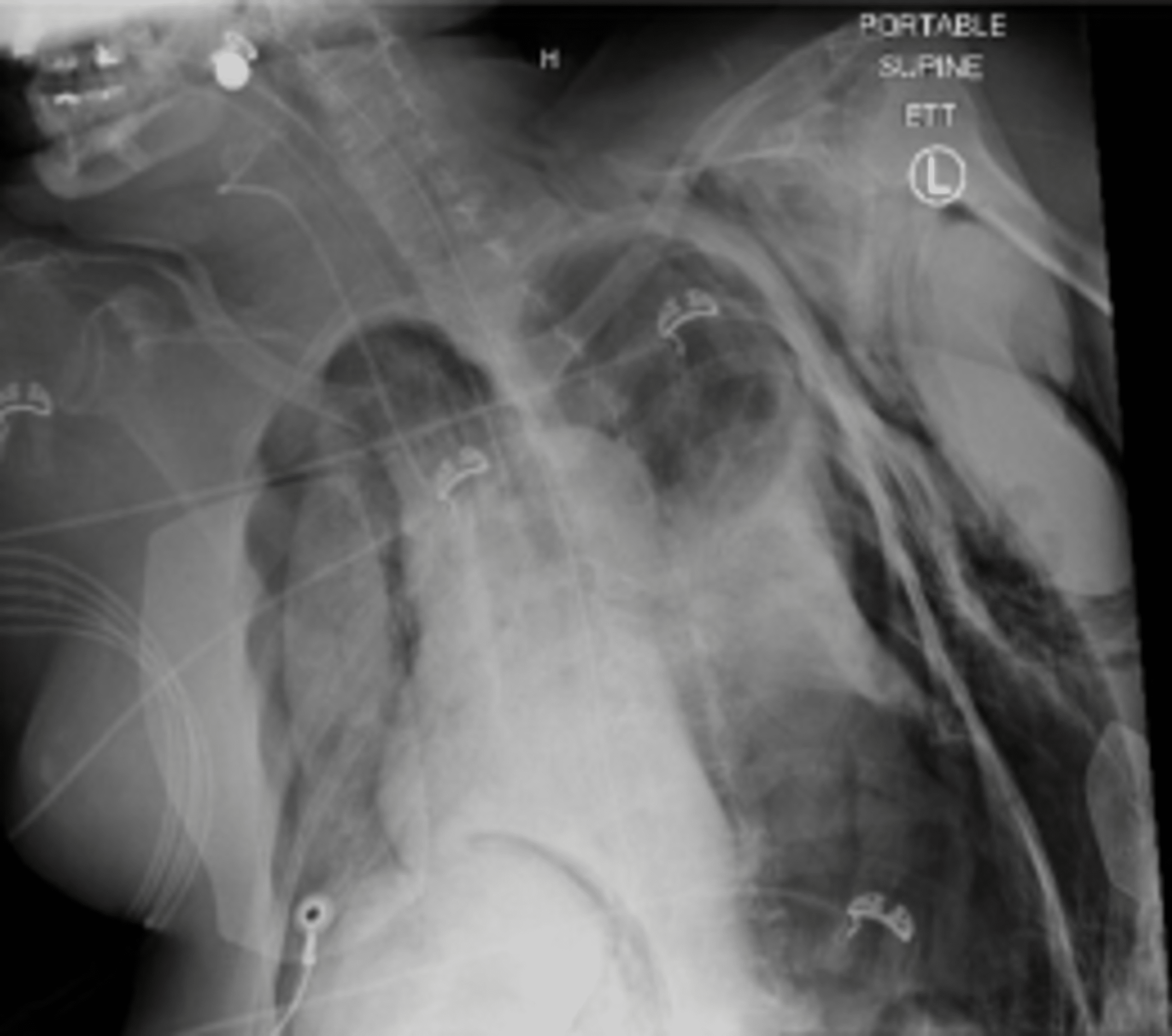 Cureus Incidence of Barotrauma in COVID19 Patients Requiring