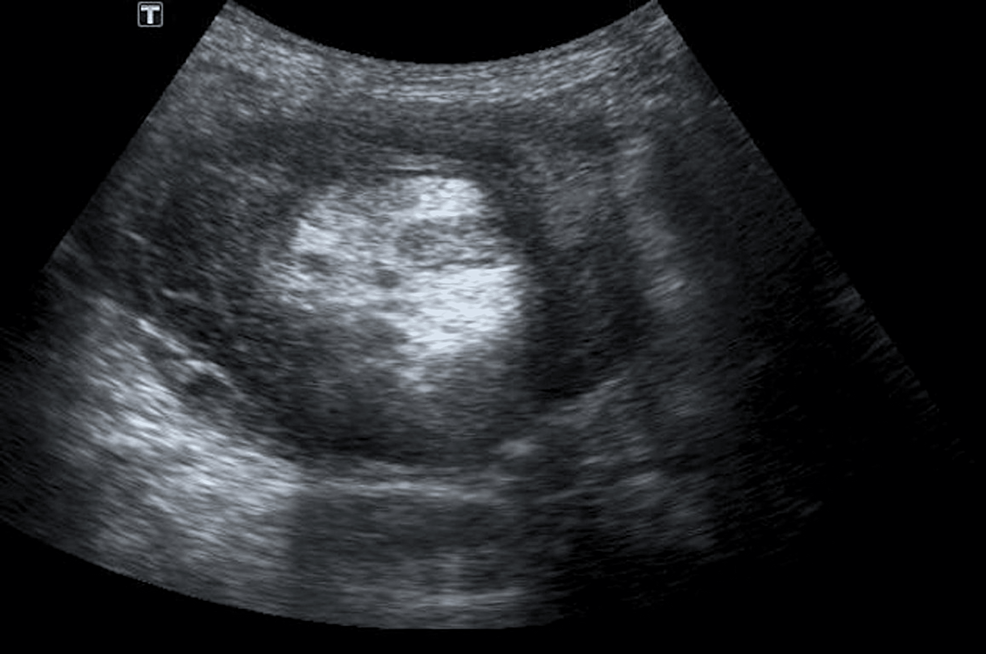 Postoperative Physiotherapy Approach for a Rare Case of Adult Ileocecal ...