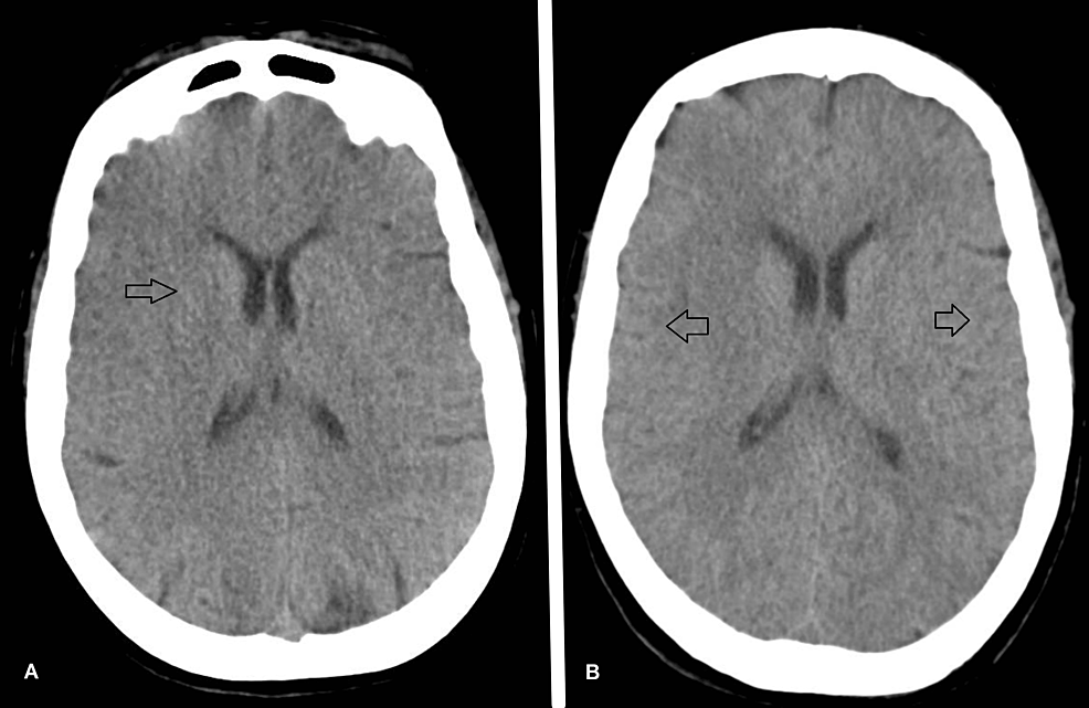 (A)-Head-CT-on-day-four.-(B)-Head-CT-on-day-12.-Both-CT-scans-show-loss-of-the-normal-differentiation-between-cortical-gray-matter-and-subcortical-white-matter.