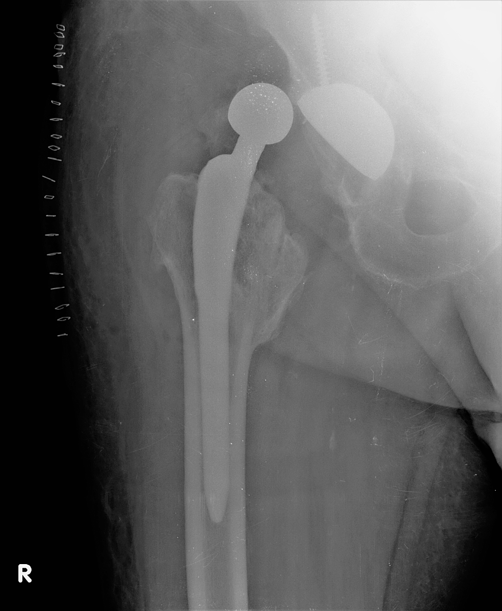 Cureus Treatment of Recurrent Total Hip Arthroplasty Dislocation