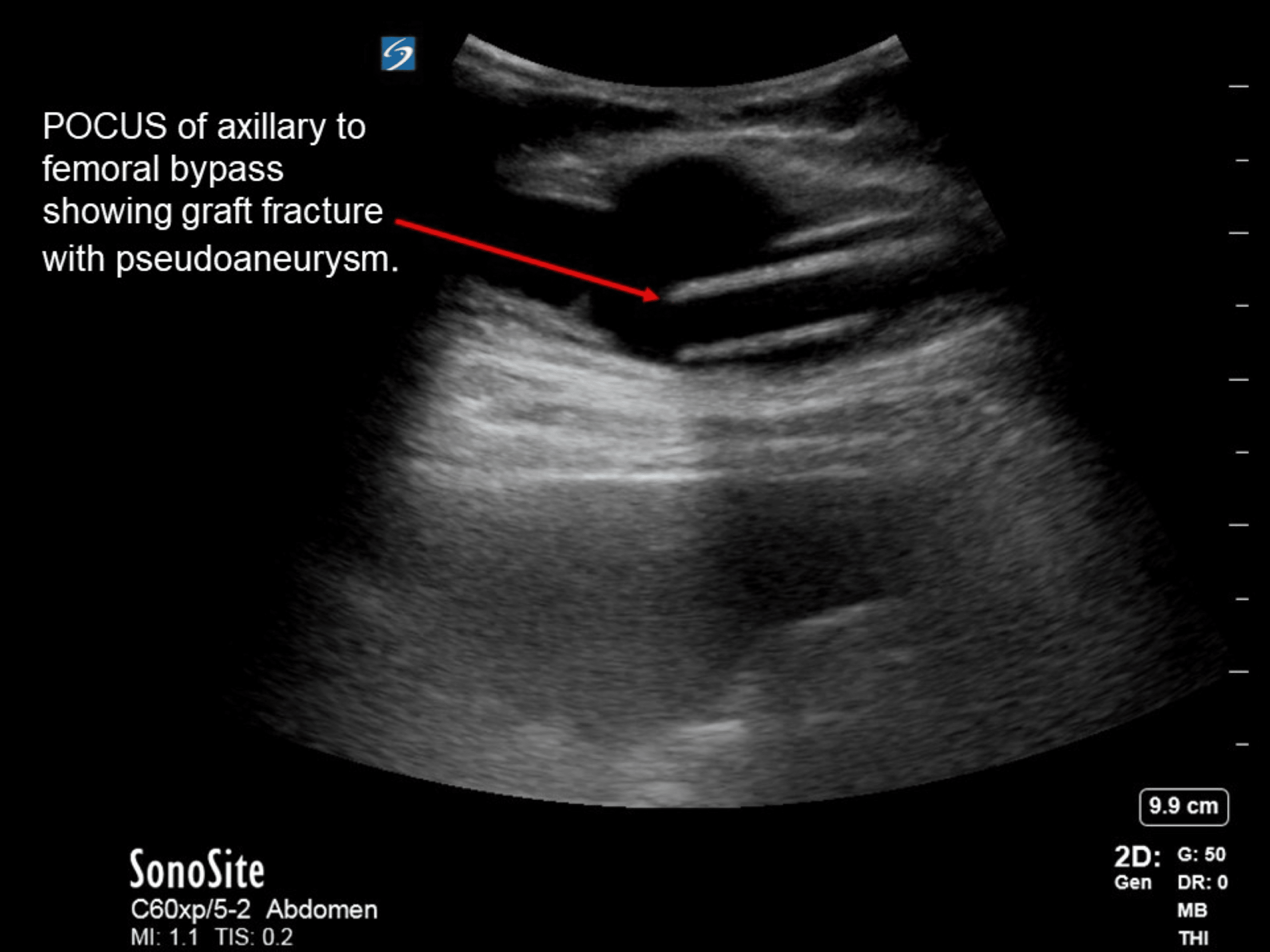 Cureus | Atraumatic Bi-femoral Axillary Bypass Graft Non-anastomotic ...