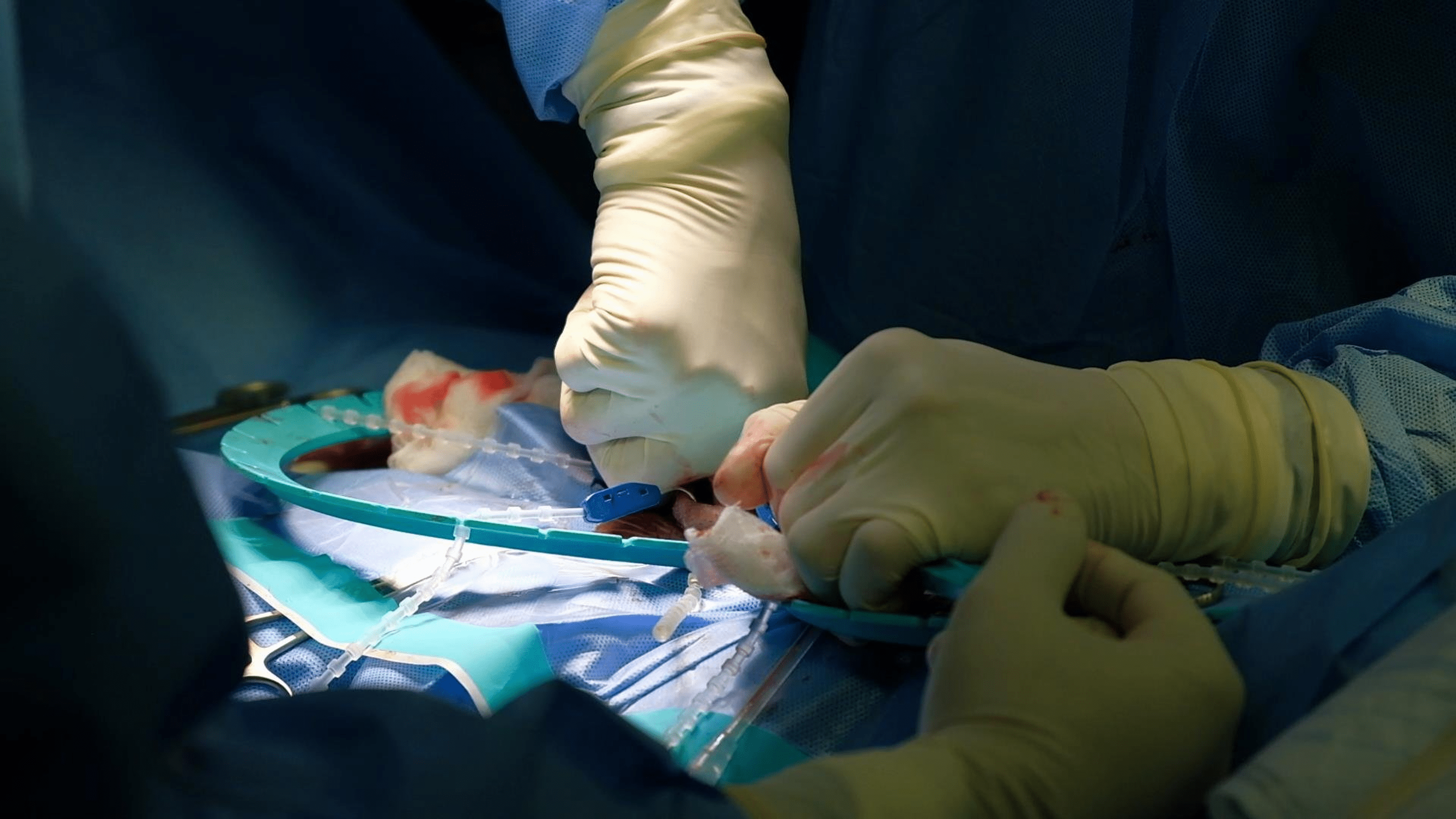 Penile prosthesis: Hãy tìm hiểu về phương pháp trợ giúp bệnh nhân bị rối loạn chức năng cương dương: bộ phận cấy ghép \