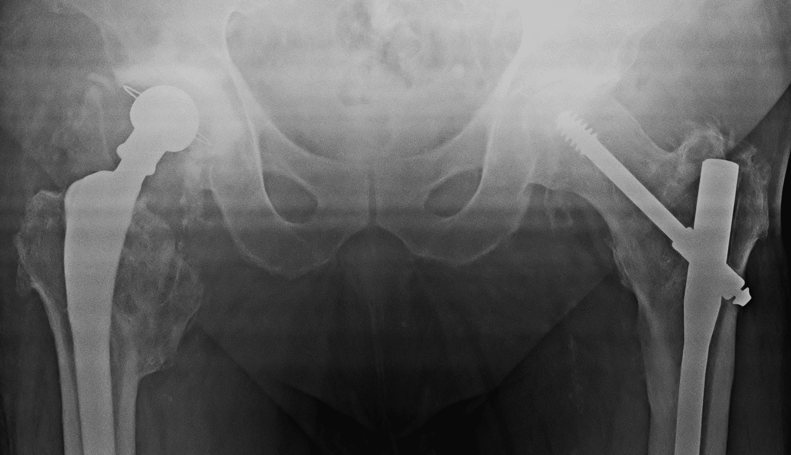 Cureus Treatment of Recurrent Total Hip Arthroplasty Dislocation
