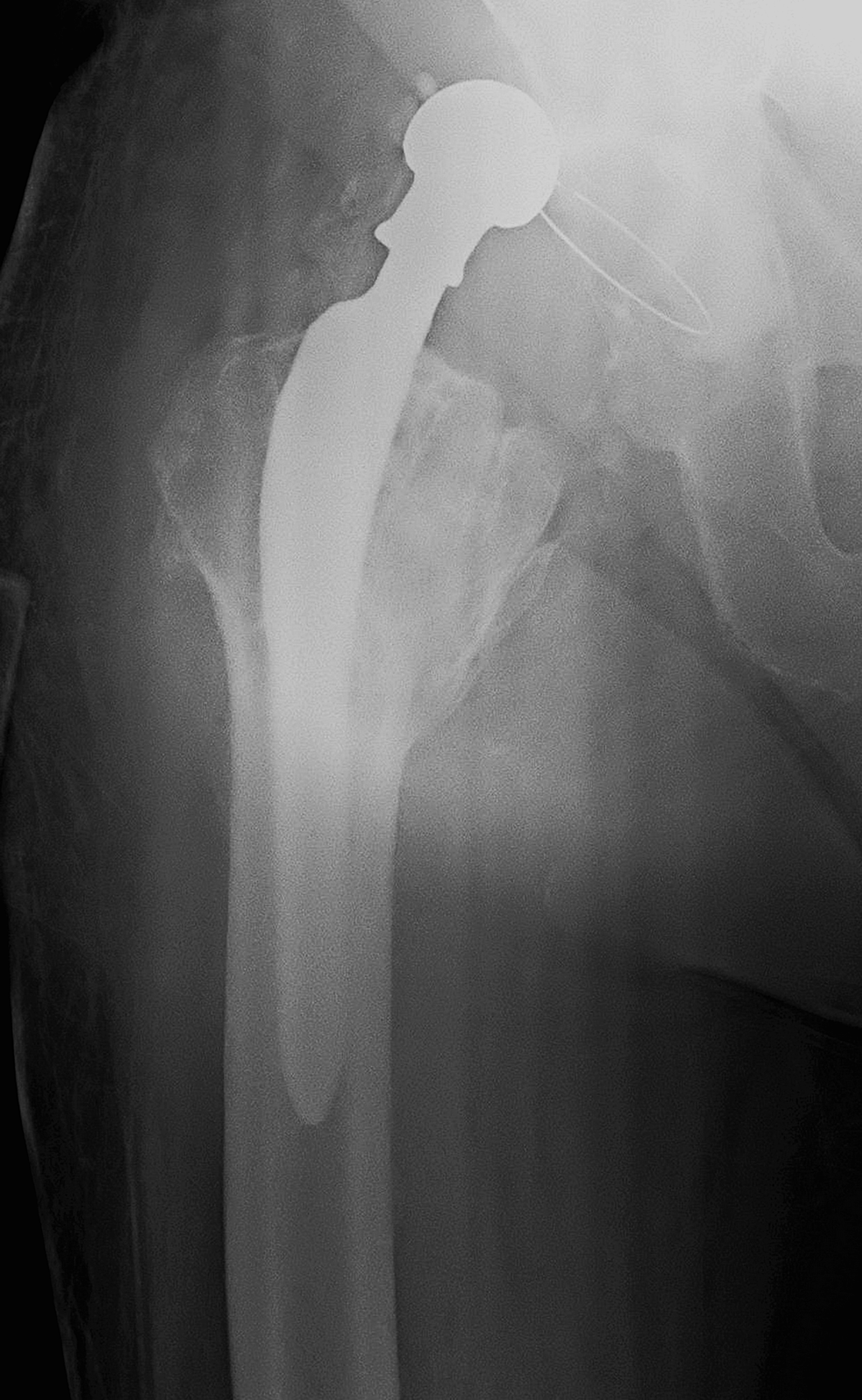 Cureus Treatment of Recurrent Total Hip Arthroplasty Dislocation