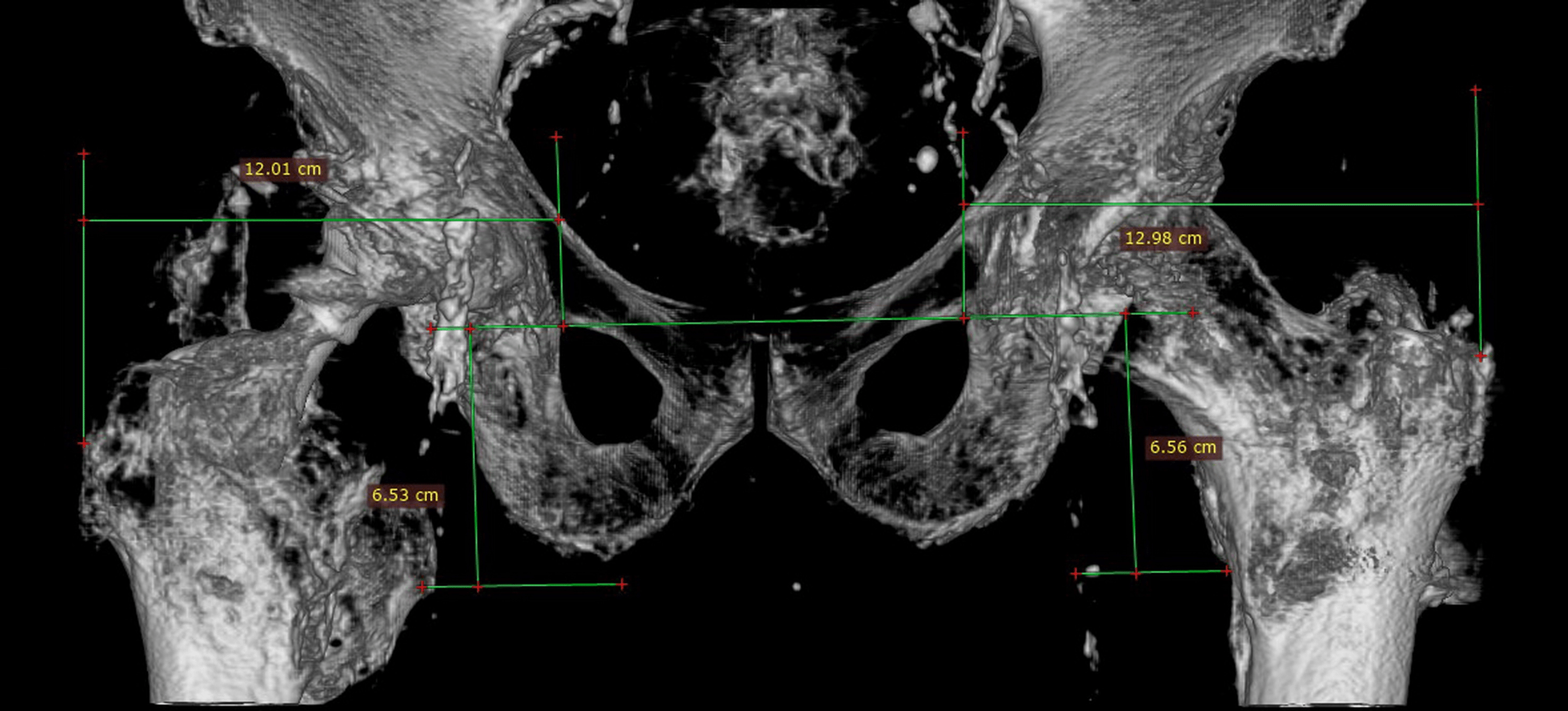 Cureus Treatment of Recurrent Total Hip Arthroplasty Dislocation