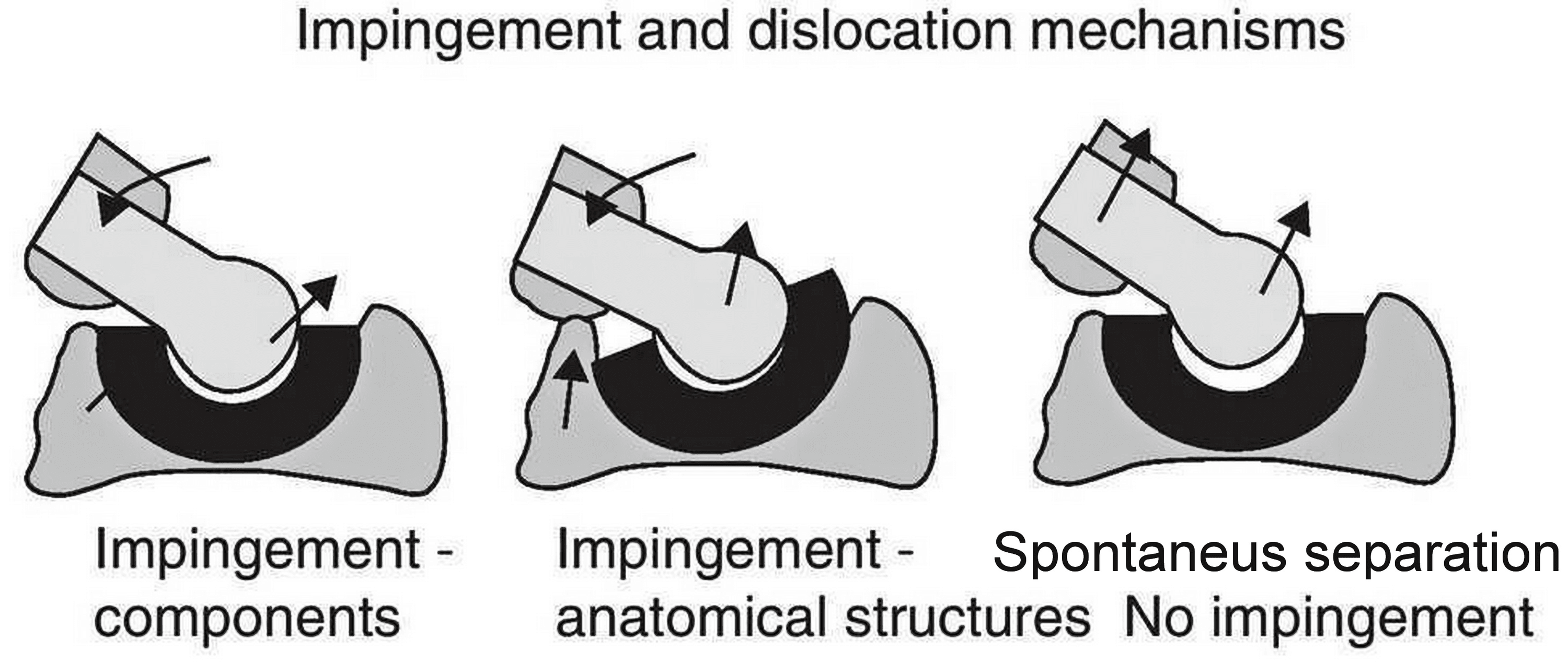Cureus Treatment of Recurrent Total Hip Arthroplasty Dislocation