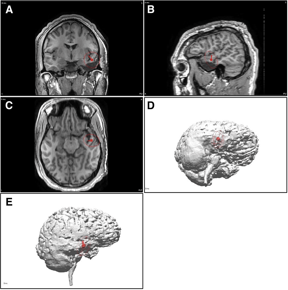 Stereoelectroencephalography (SEEG), Neurological Surgery