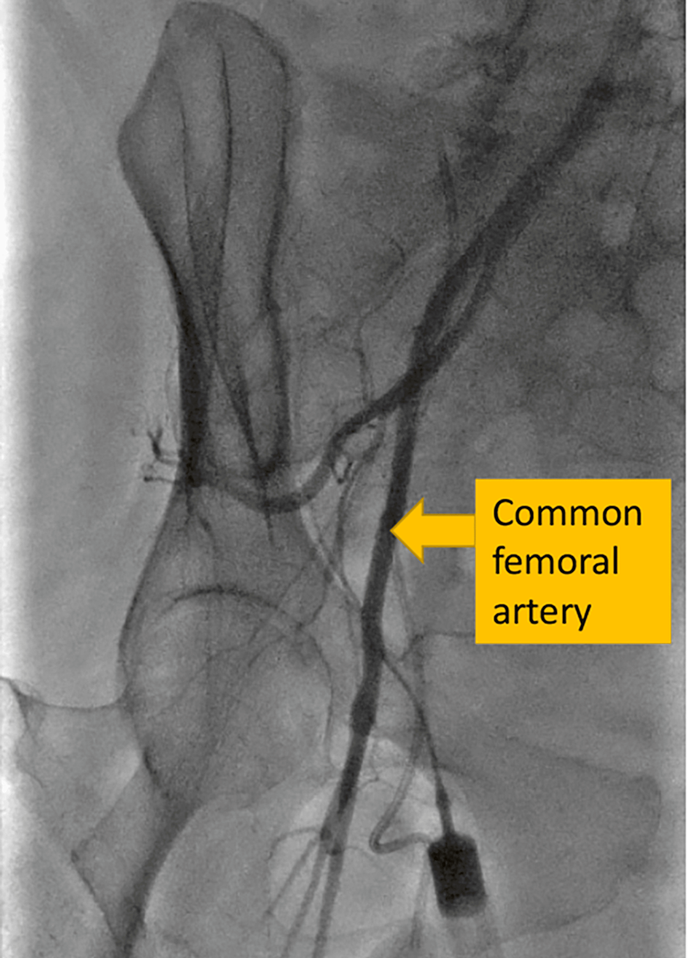 Direct surgical access to right femoral vessels for veno-arterial