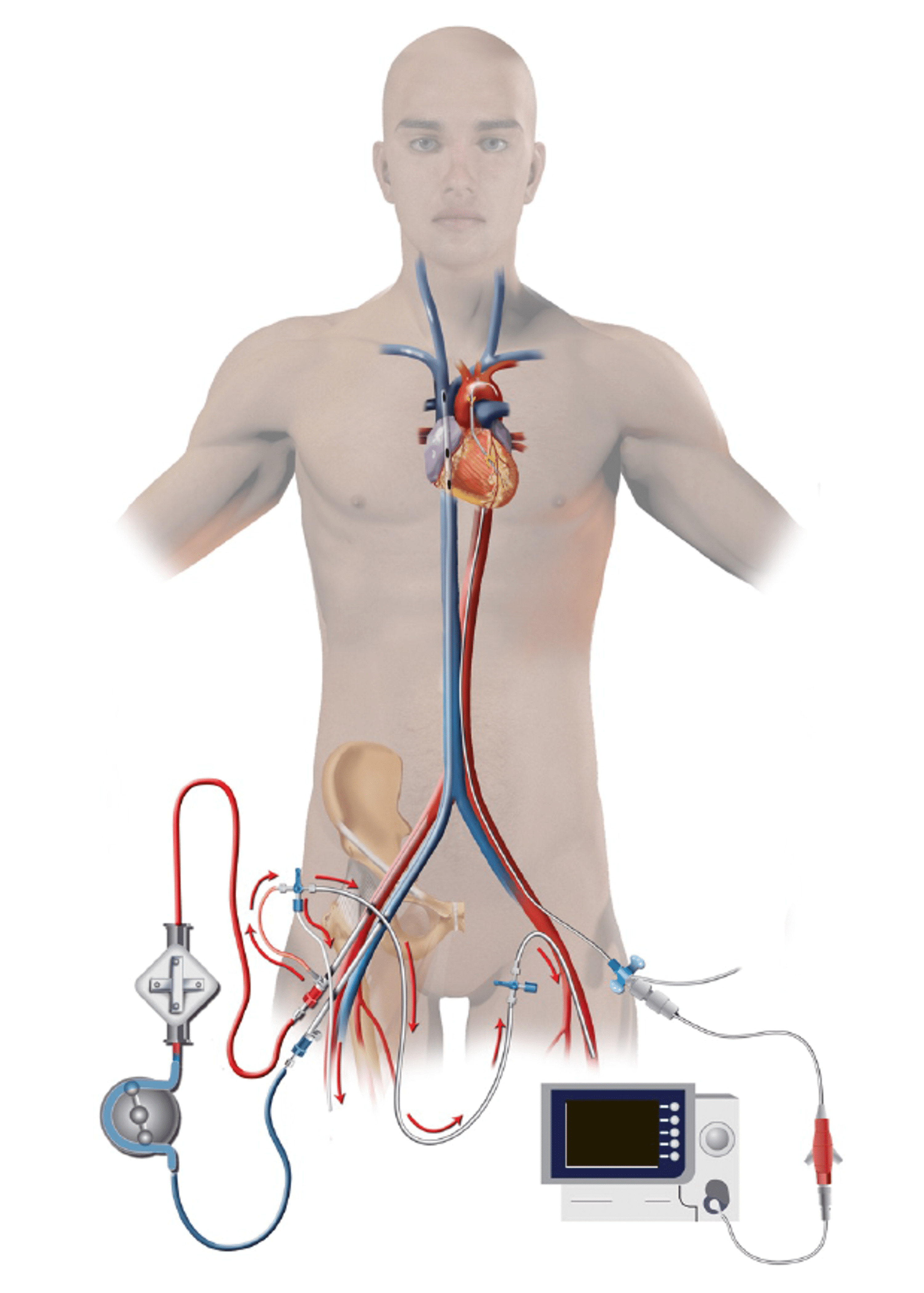 vv ecmo cannula placement