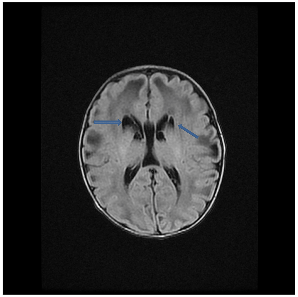 Axial-T2-Flair-sequence-shows-multiple-subependymal-germinolytic-periventricular-cysts.-Bilateral-subcortical-parenchymal-cysts-are-also-noted-in-bilateral-parietal-lobe-left-more-than-right.