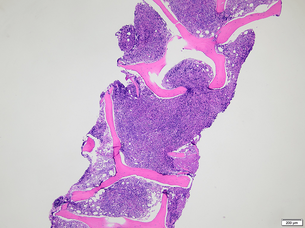 Bone-marrow-biopsy-showing-hypercellular-marrow-with-greater-than-95%-cellularity-(hematoxylin-and-eosin-stained-section,-40×)