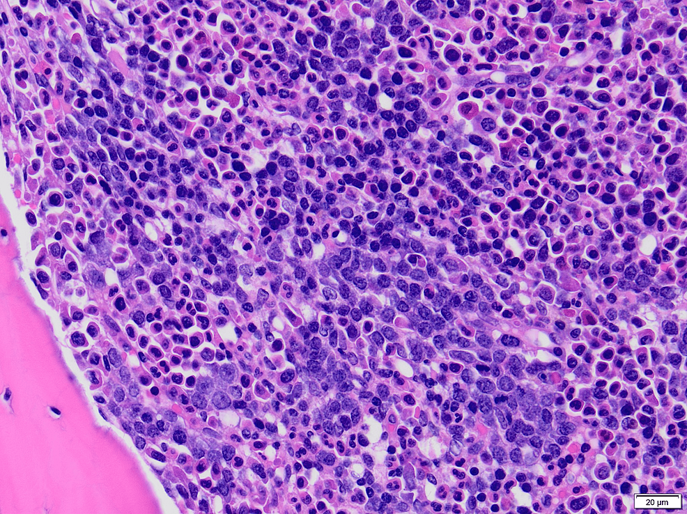 Bone-marrow-biopsy-showing-increased-erythroid-precursors-including-clusters-of-erythroblasts-confirmed-by-positive-E-cadherin-stain-(hematoxylin-and-eosin-stained-section,-400×;-E-cadherin-not-shown)
