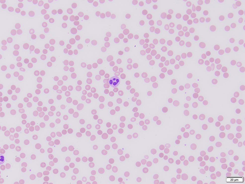 Peripheral-blood-smear-showing-spherocytes-and-thrombocytopenia-(Diff-Quik-stain,-400×)