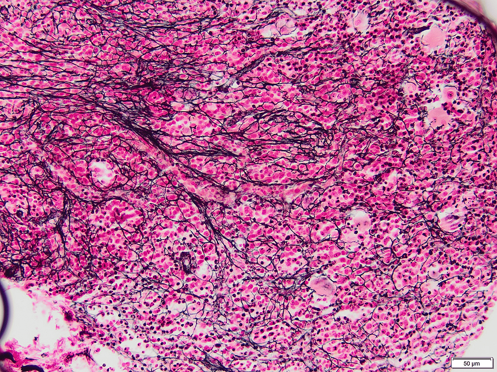 Reticulin-stain-showing-myelofibrosis,-MF1-2-(200×,-bottom-right)