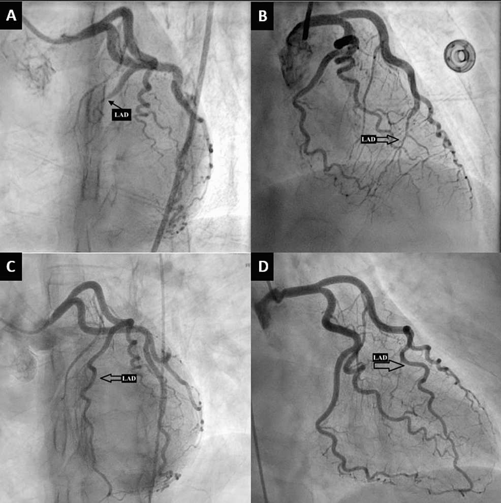 Cureus Complete Recovery of an Occluded Coronary Artery Secondary to